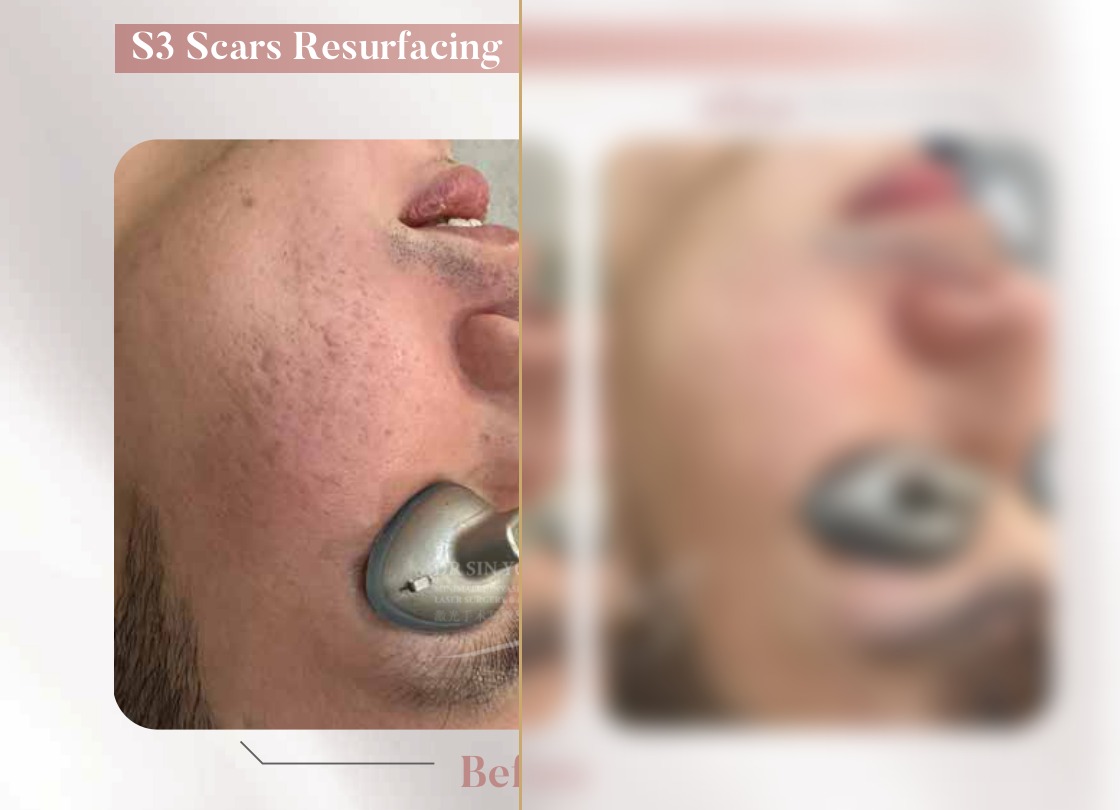 S3 Resurfacing Lift Laser — Scars Resurfacing