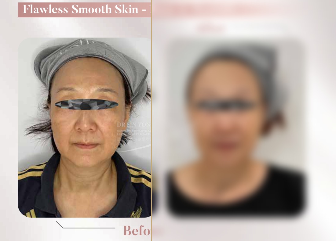 FSX Laser — Face & Necklift