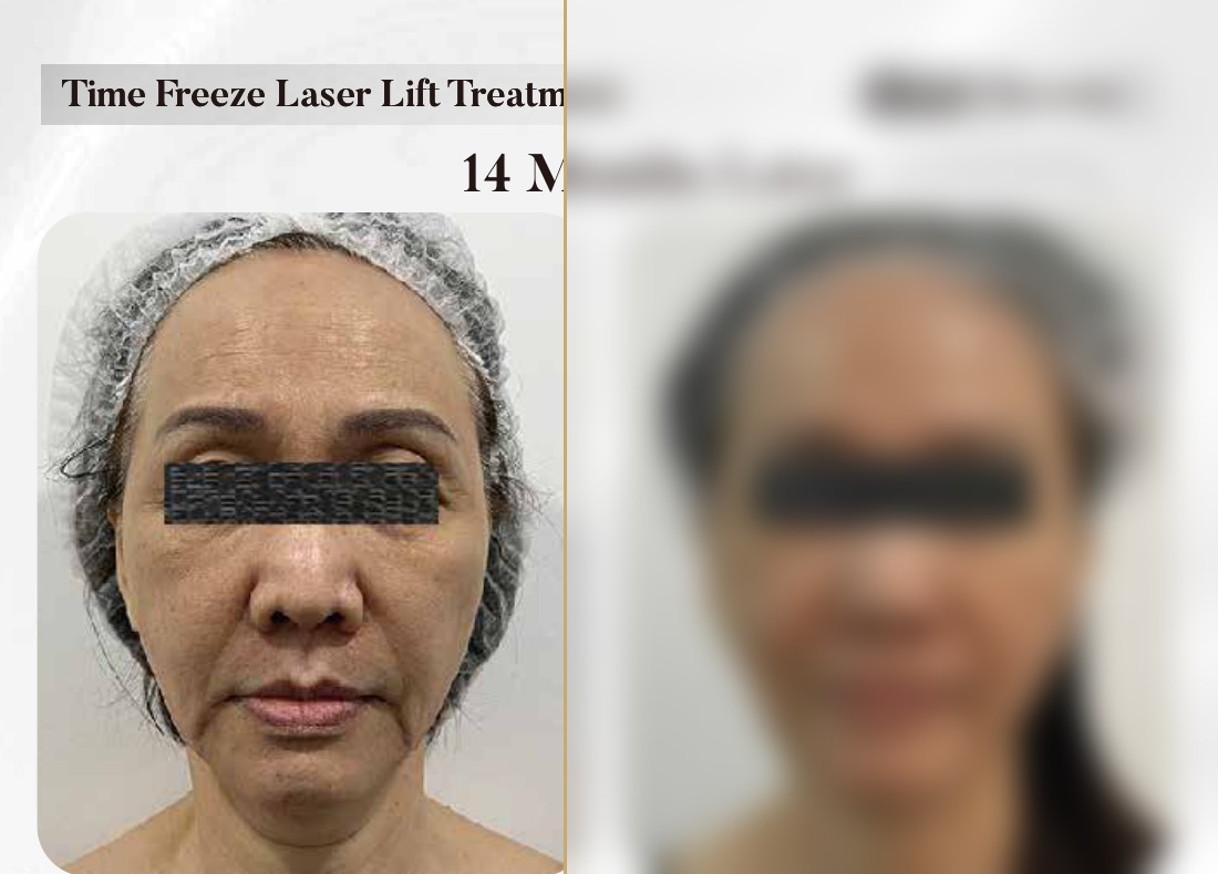 Time Freeze Laser Lift — 14 Months Later, Frontal (Single Session)