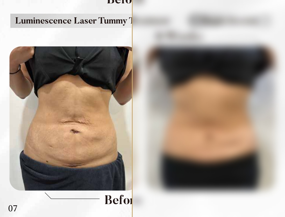 Luminescence Laser — Tummy Treatment, 8 Weeks (Single Session)