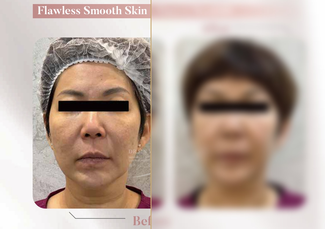 FSX Laser — Face & Necklift